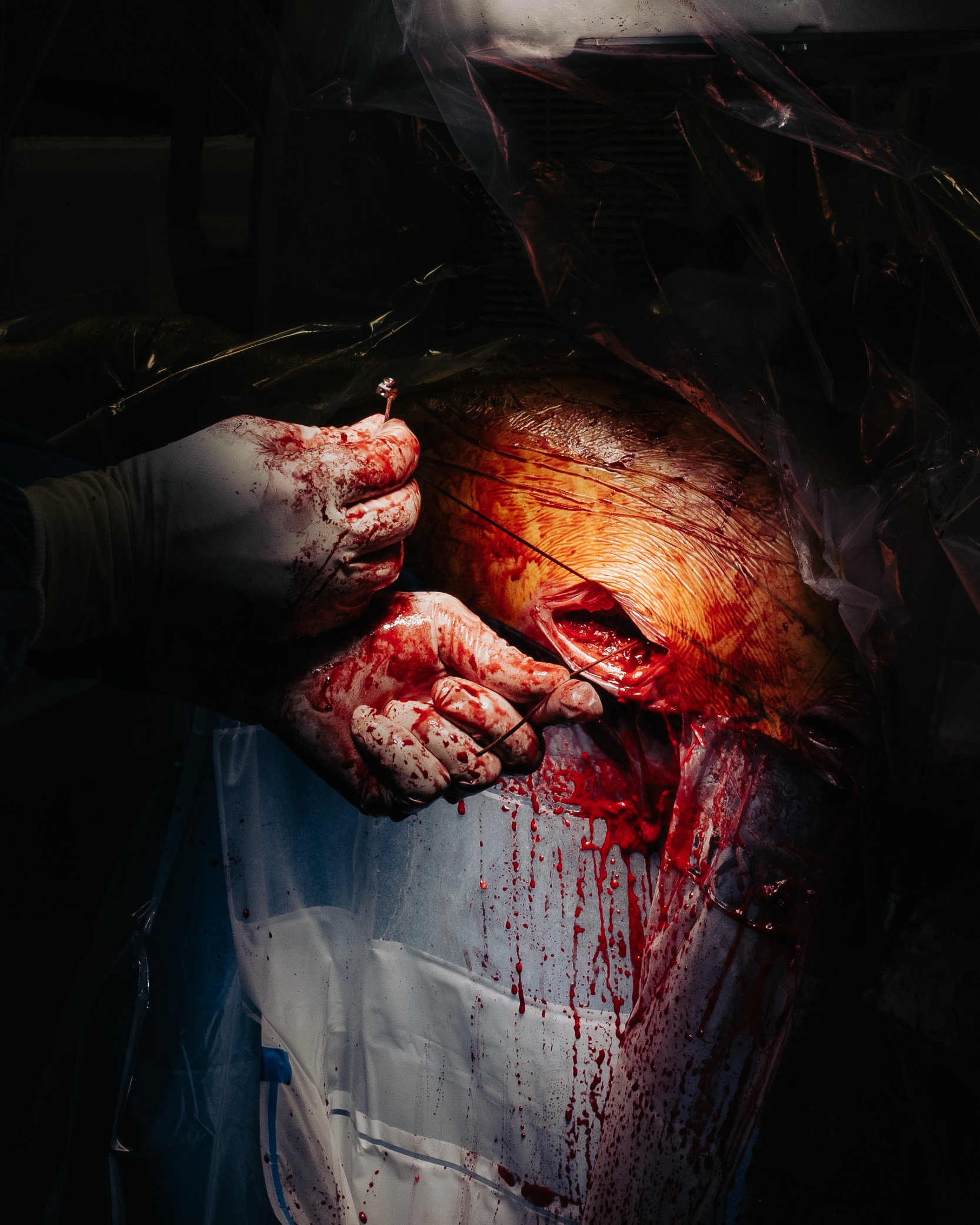 3 months in a surgery room.